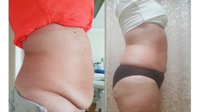 Before and after comparison showing abdominal weight loss and body transformation results