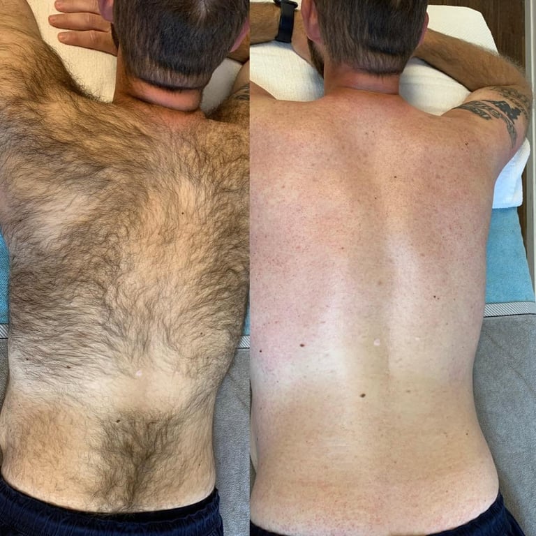 Before and after comparison of male torso showing hair removal results, with left side hairy and right side hairless